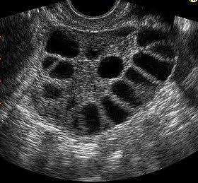 PCOS